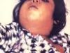 דיפתריה מחלת גרון (קרמת לועזית diphtheria) בלשון התלמוד: אסכרה, סרונכי.