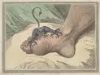 מחלת השגדון (gout) בלשון התלמוד: פודגרא, צינית, בת ארעא.