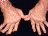 דלקת מפרקים – שגרון (ARTHRITIS) בלשון התלמוד שיגרונא