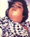 דיפתריה מחלת גרון (קרמת לועזית diphtheria) בלשון התלמוד: אסכרה, סרונכי.