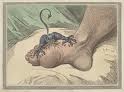 מחלת השגדון (gout) בלשון התלמוד: פודגרא, צינית, בת ארעא.