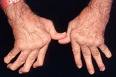 דלקת מפרקים – שגרון (ARTHRITIS) בלשון התלמוד שיגרונא